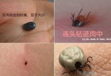 【鲍医生专栏】被蜱虫咬了怎么办?