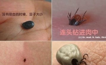【鲍医生专栏】被蜱虫咬了怎么办?