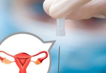 在比利时,每年有190名女性死于宫颈癌!