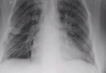 【新增2082例】比利时两例新冠患者肺移植手术成功