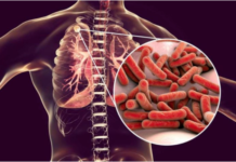 美国暴发罕见结核病 涉及多州丨国际热点速递