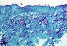 【猴痘病毒】比利时发现并确诊一例!